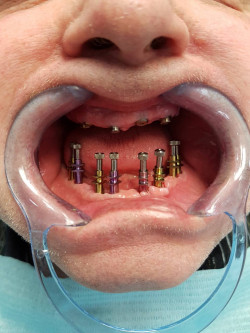 Как выполняют имплантацию зубов?