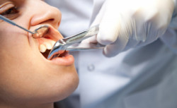 Особенности удаления зубов