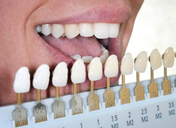 Как ставят виниры на зубы?