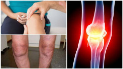 Остеоартроз суставов: симптомы и чем лечить? 