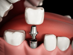 Как осуществляется имплантация зубов?