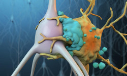 Как лечится болезнь бокового нейрона?