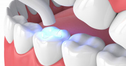 Основные правила пломбирования зубов