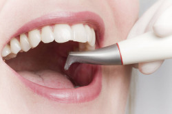 Чистка зубов Air-Flow: новый подход к оральной гигиене