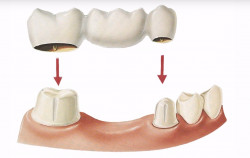 Коронки на зубы: восстановление улыбки с пользой и эстетикой